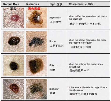 胸有大痣|身上7种痣一定会癌变！